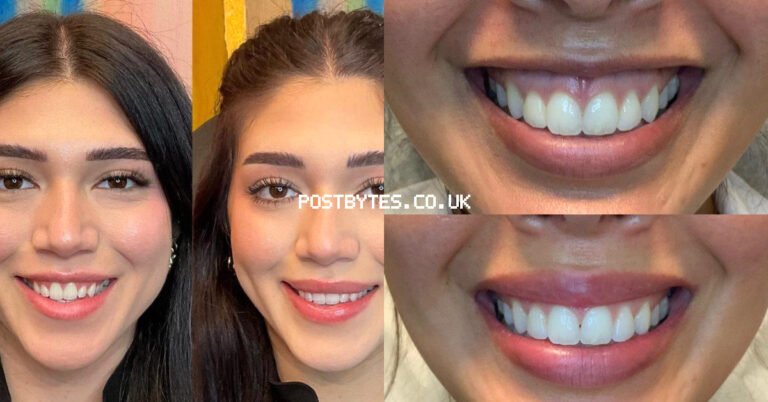 Lip Flip Before and After: What to Expect from the Procedure